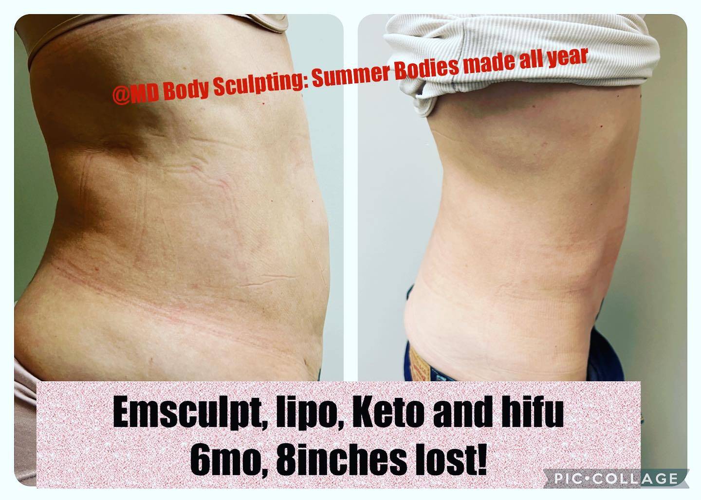 Body Sculpting, Lipo Hifu